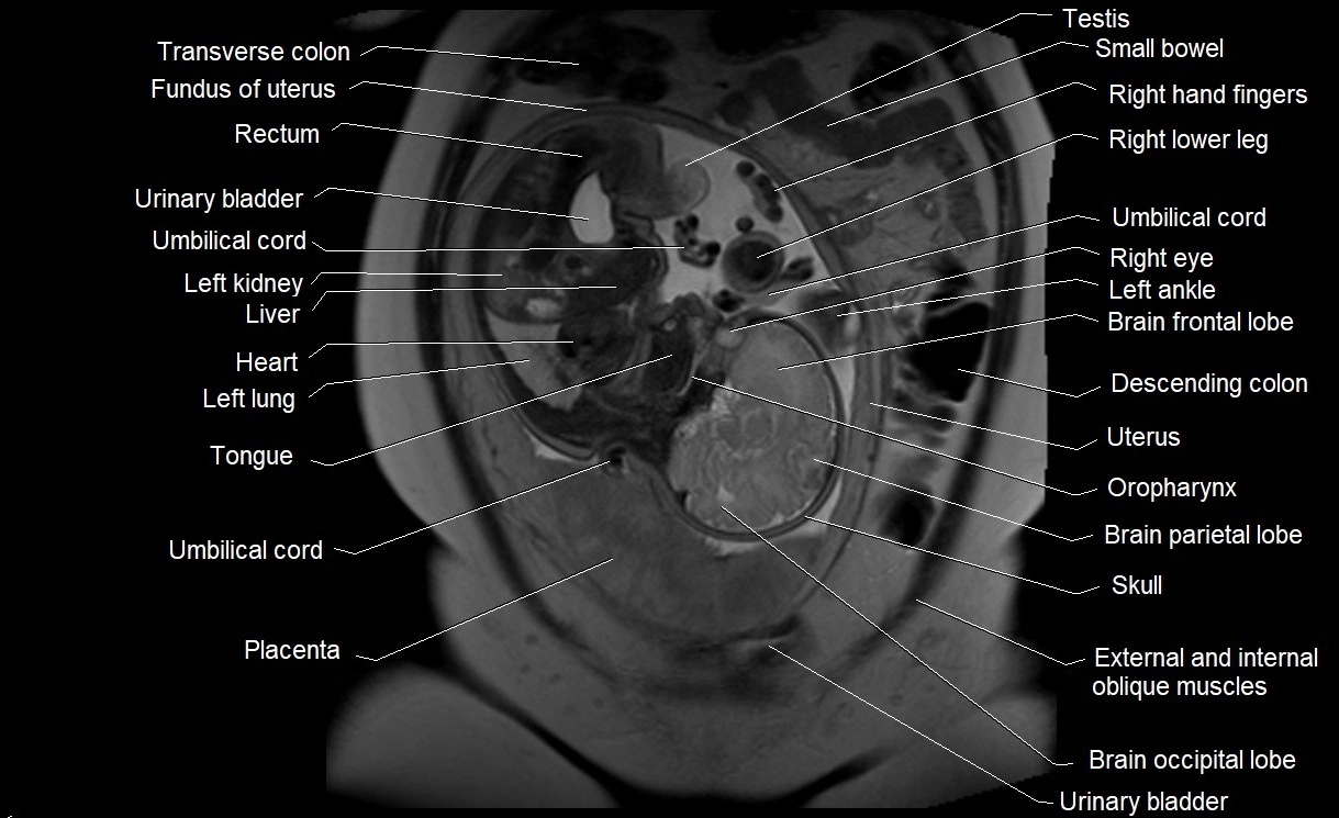 MRI Anatomy of pregnancy image 12.webp